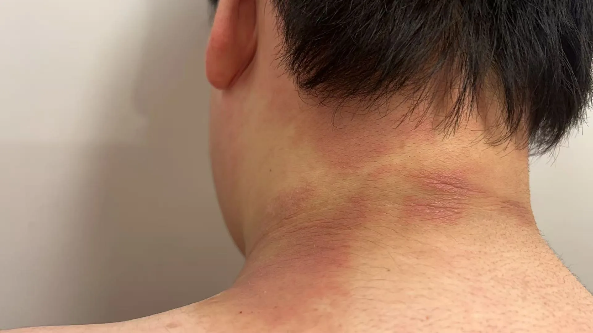 温州进入花粉过敏高发季 医院每天接诊百余人