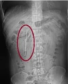 水银体温计“潜伏”肚内20年 随时可能引发肠穿孔大出血