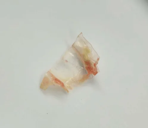 七岁女童反复喘息久治不愈 竟是一片塑料薄膜藏在气道里