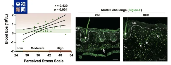 压力大会加重皮炎 中国科学家首次发现科学证据