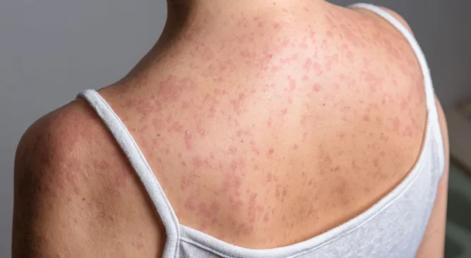 英媒：伦敦多所学校暴发“快速传播”麻疹疫情，已致数十人感染